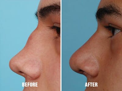 Revision Rhinoplasty before and after, lateral left.