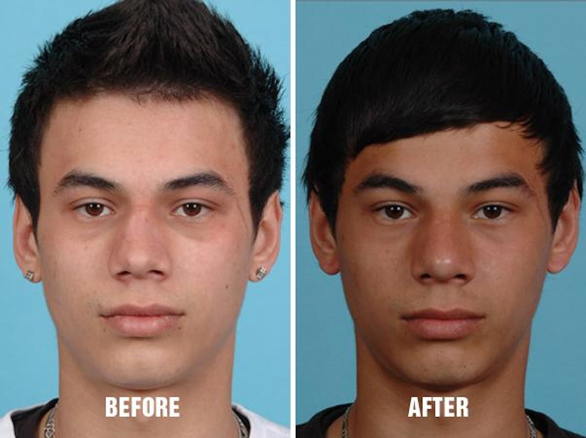 Revision Rhinoplasty before and after, frontal.