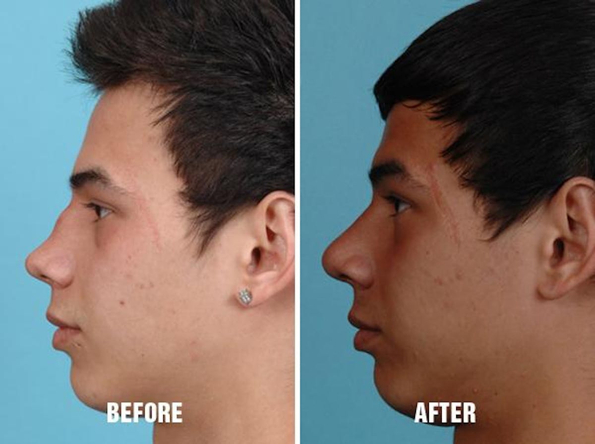 Revision Rhinoplasty before and after, lateral left.