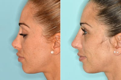 Revision Rhinoplasty before and after, lateral left.