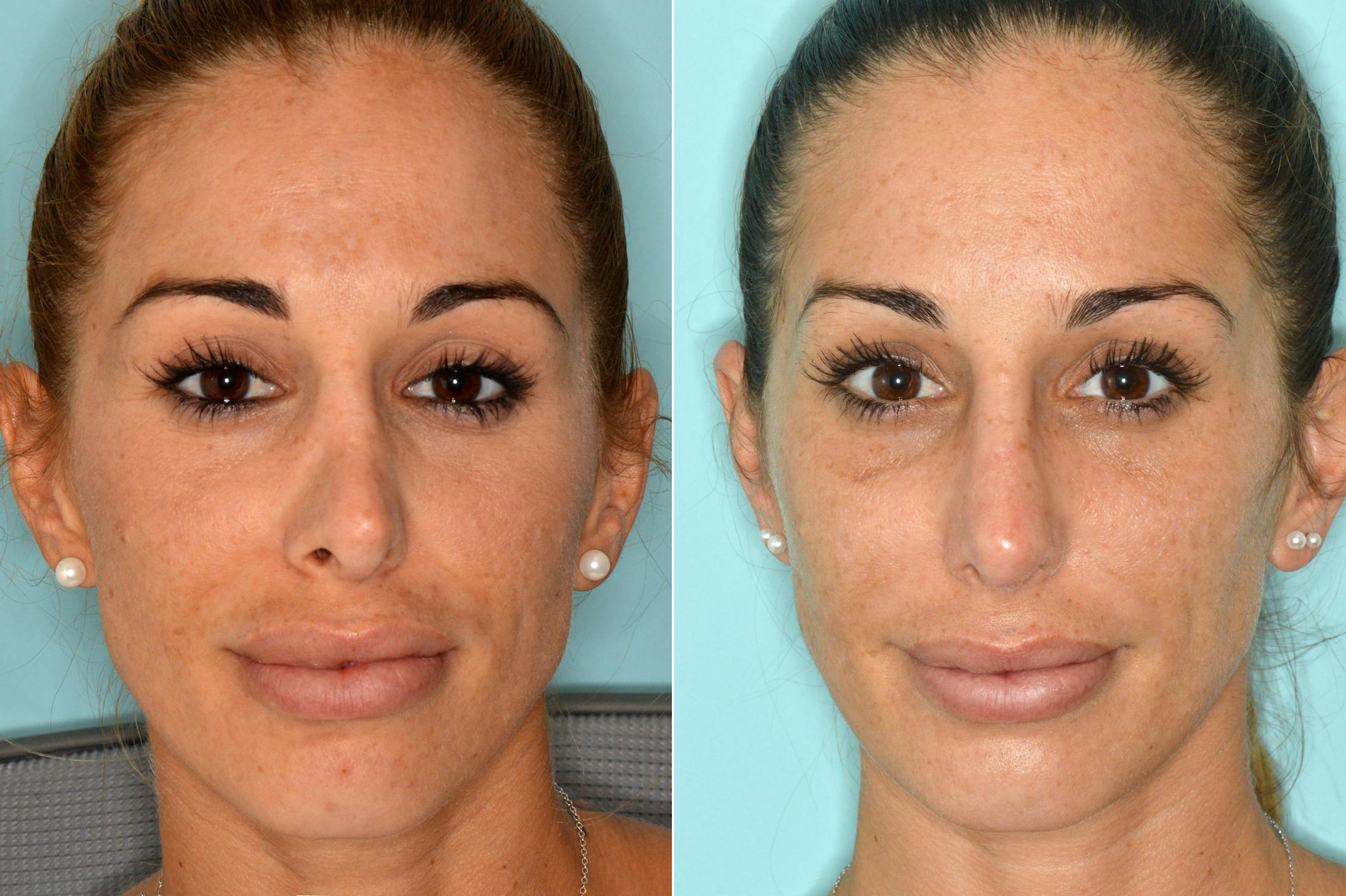 Revision Rhinoplasty before and after, frontal.