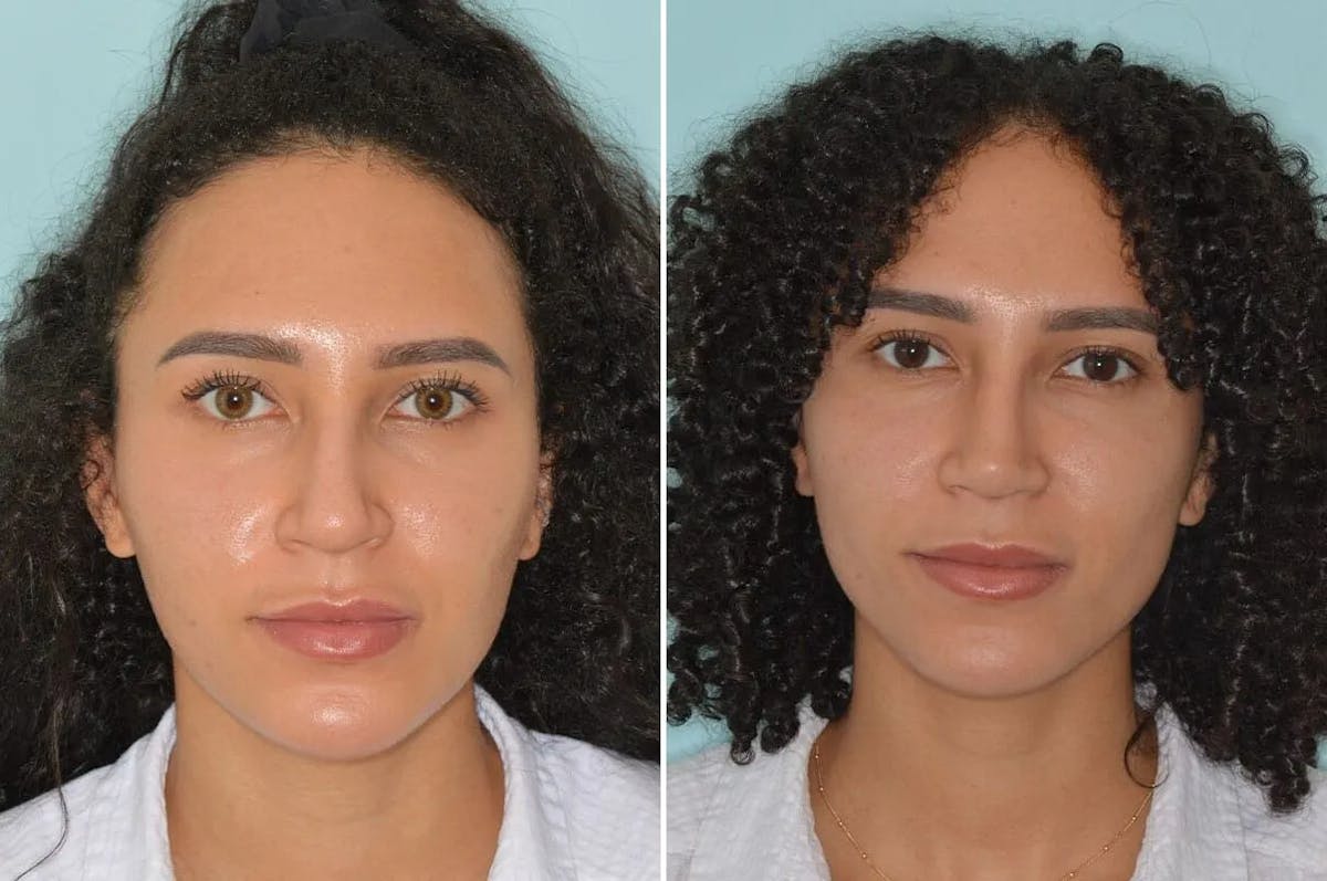 Ethnic Rhinoplasty before and after, frontal.