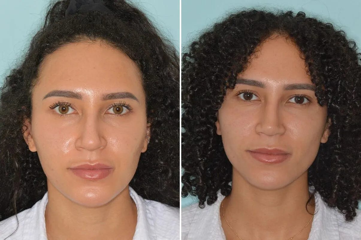 Ethnic Rhinoplasty before and after, frontal.
