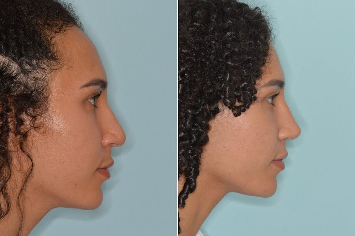 Ethnic Rhinoplasty before and after, lateral right.