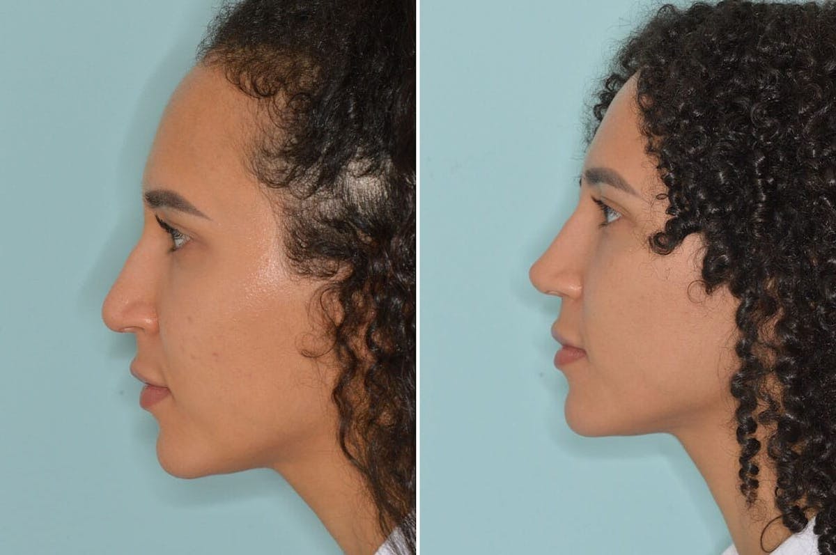 Ethnic Rhinoplasty before and after, lateral left.