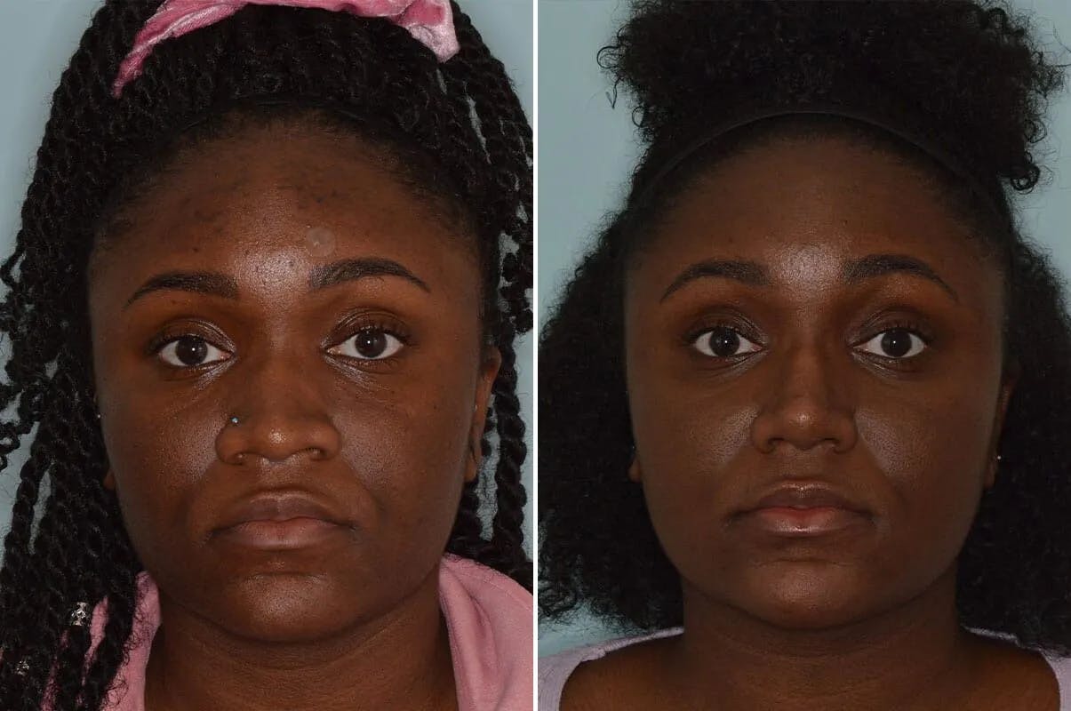 Ethnic Rhinoplasty before and after, frontal.