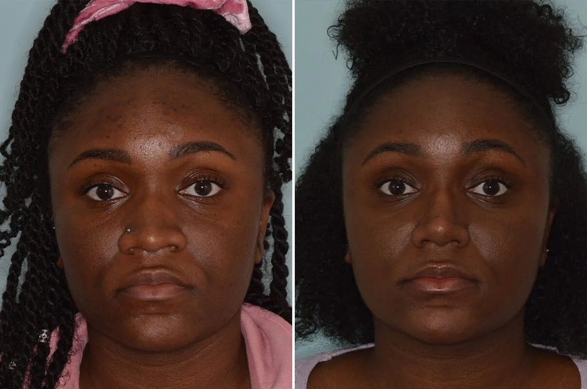 Ethnic Rhinoplasty before and after, frontal.