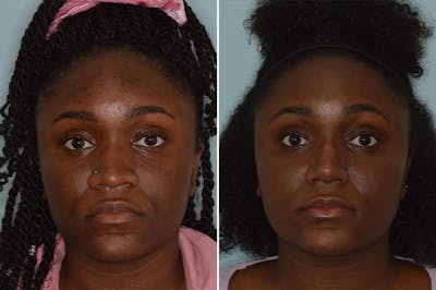 Ethnic Rhinoplasty before and after, frontal.
