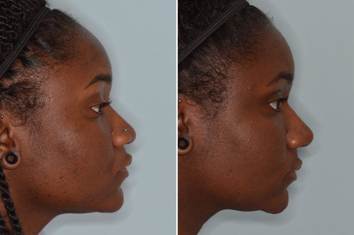 Ethnic Rhinoplasty before and after, lateral right.