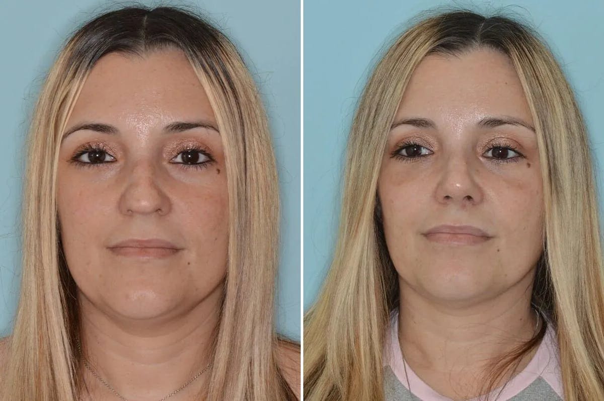 Ethnic Rhinoplasty before and after, frontal.