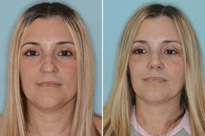 Ethnic Rhinoplasty before and after, frontal.