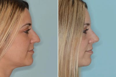 Ethnic Rhinoplasty before and after, lateral right.