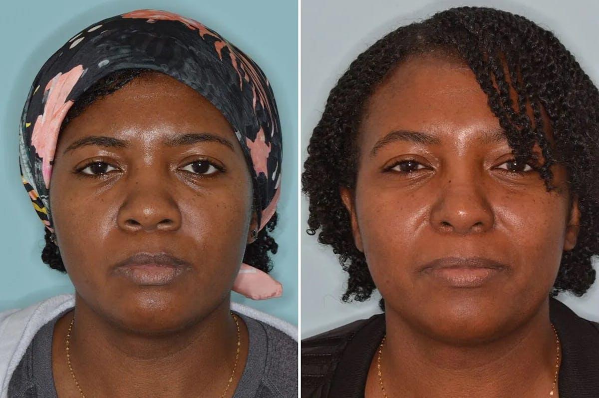 Ethnic Rhinoplasty before and after, frontal.