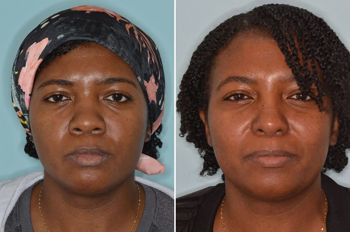 Ethnic Rhinoplasty before and after, frontal.