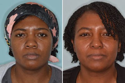 Ethnic Rhinoplasty before and after, frontal.