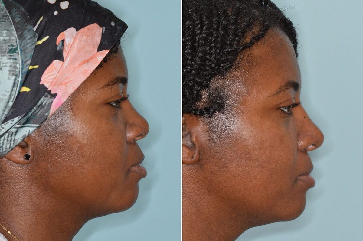 Ethnic Rhinoplasty before and after, lateral right.