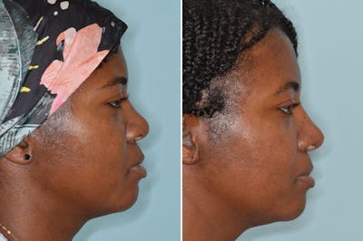 Ethnic Rhinoplasty before and after, lateral right.