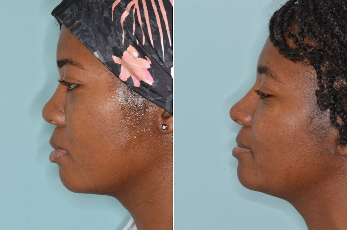 Ethnic Rhinoplasty before and after, lateral left.