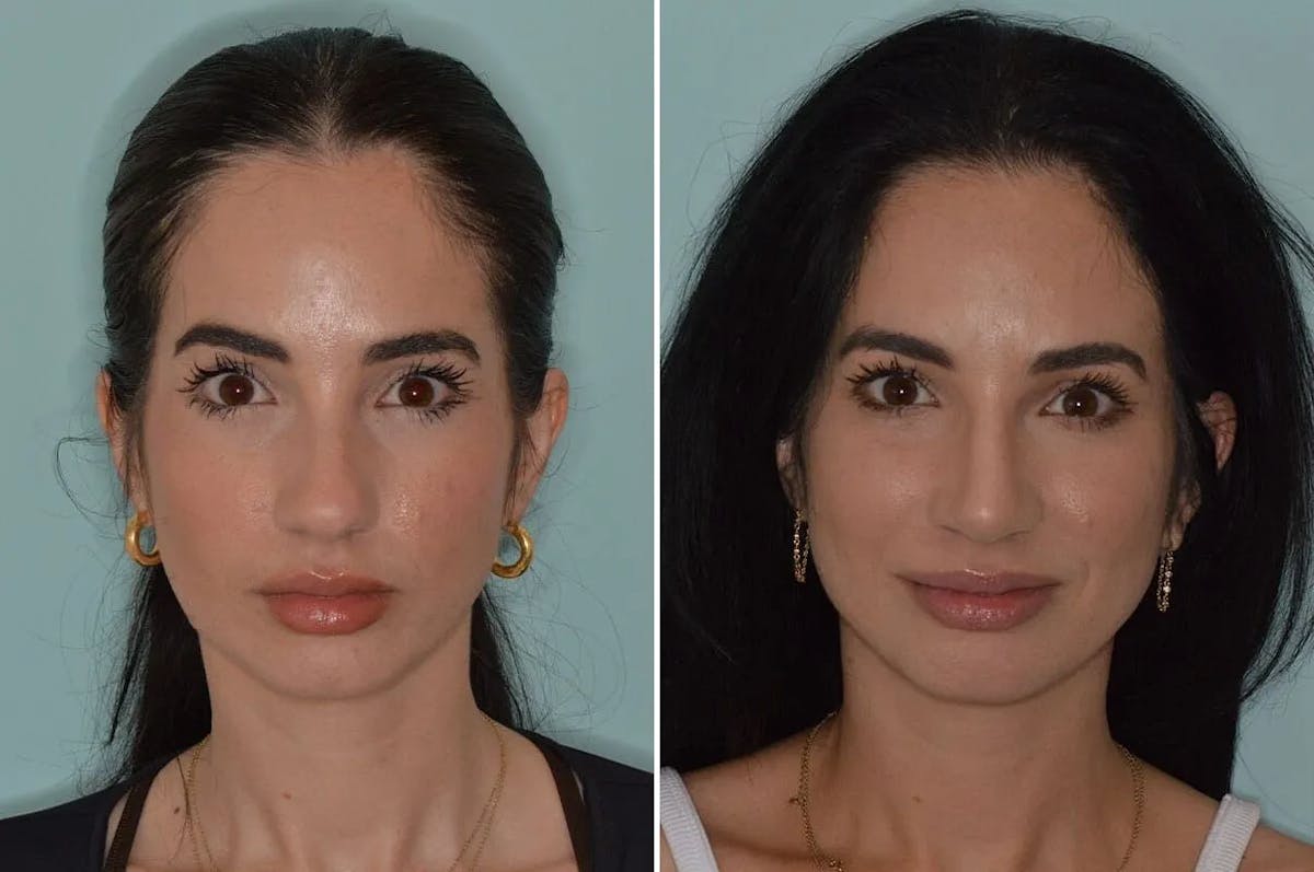 Ethnic Rhinoplasty before and after, frontal.