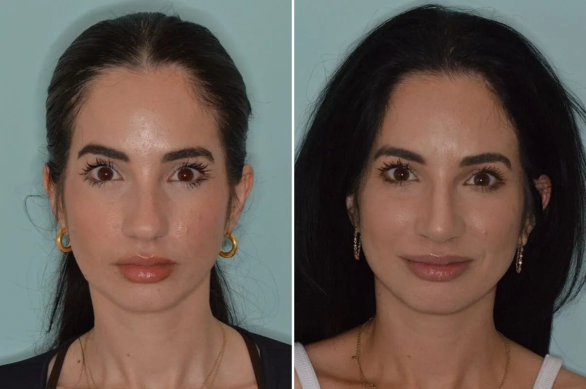 Ethnic Rhinoplasty before and after, frontal.