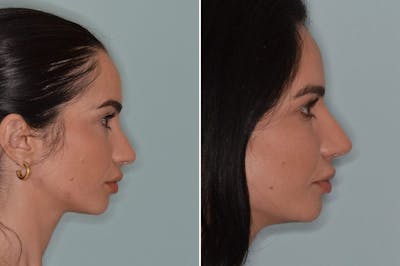 Ethnic Rhinoplasty before and after, lateral right.