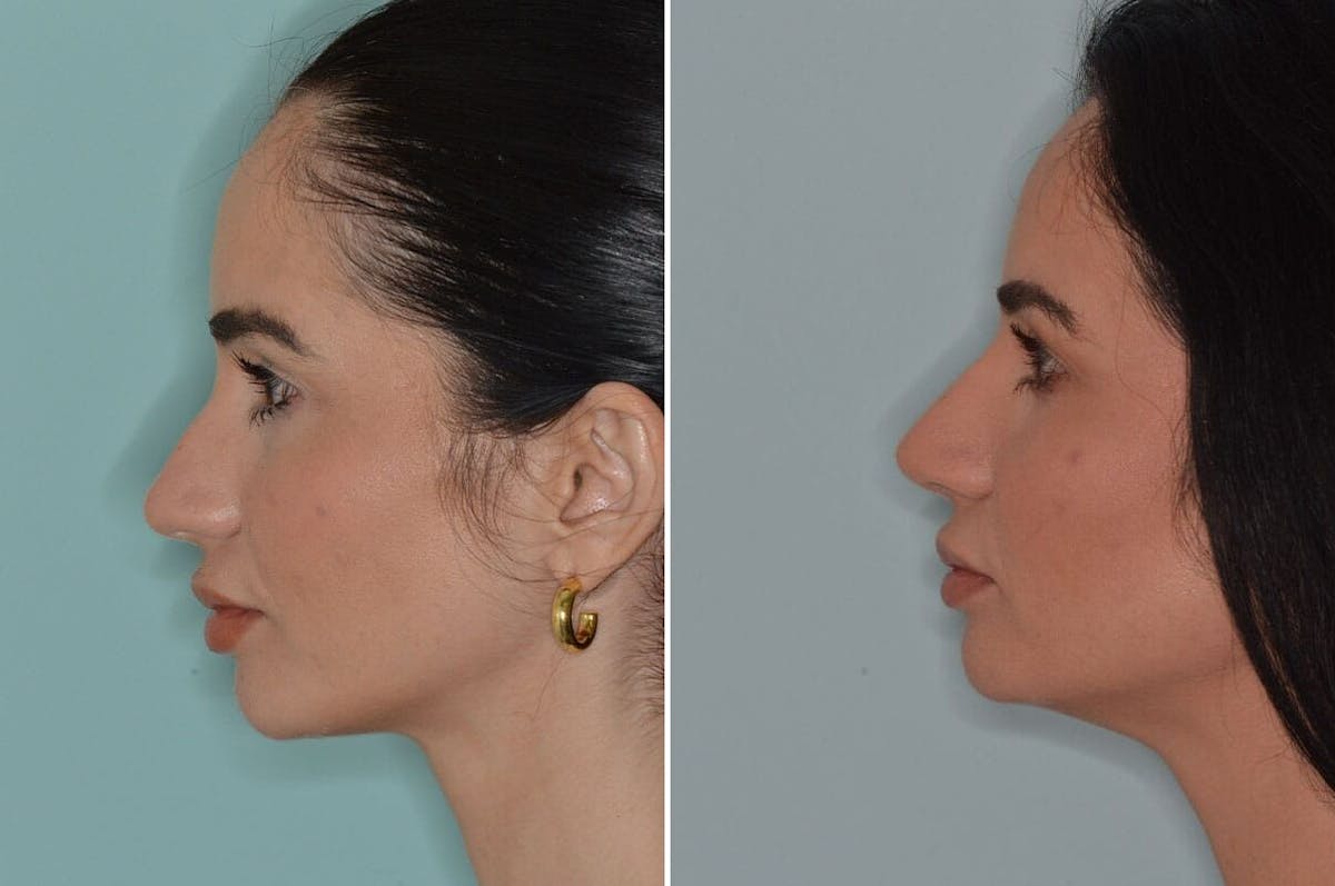 Ethnic Rhinoplasty before and after, lateral left.