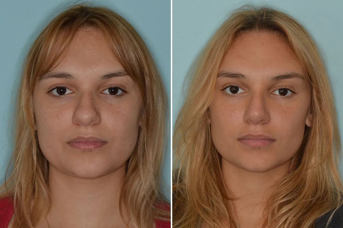 Ethnic Rhinoplasty before and after, frontal.