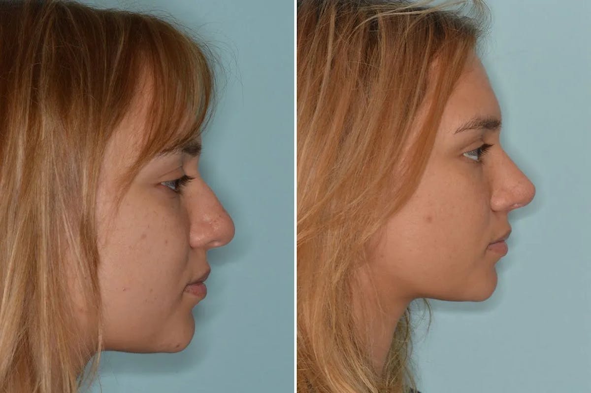 Ethnic Rhinoplasty before and after, lateral right.