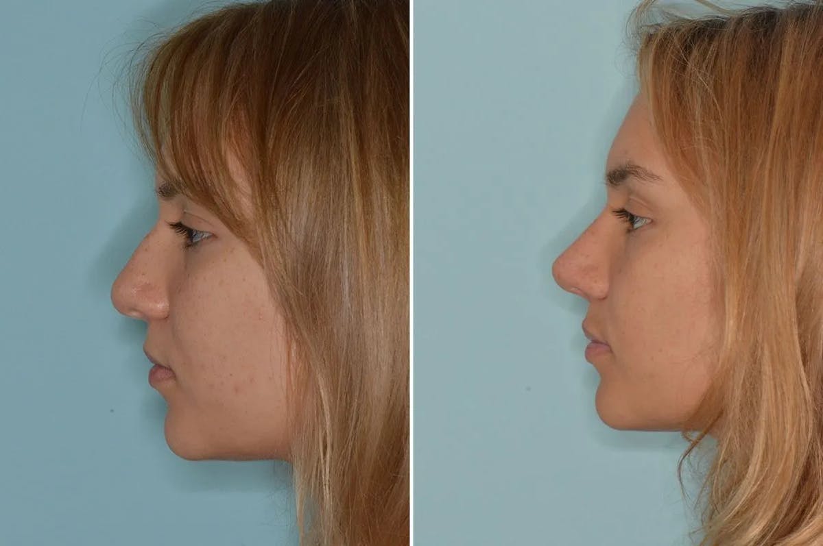 Ethnic Rhinoplasty before and after, lateral left.