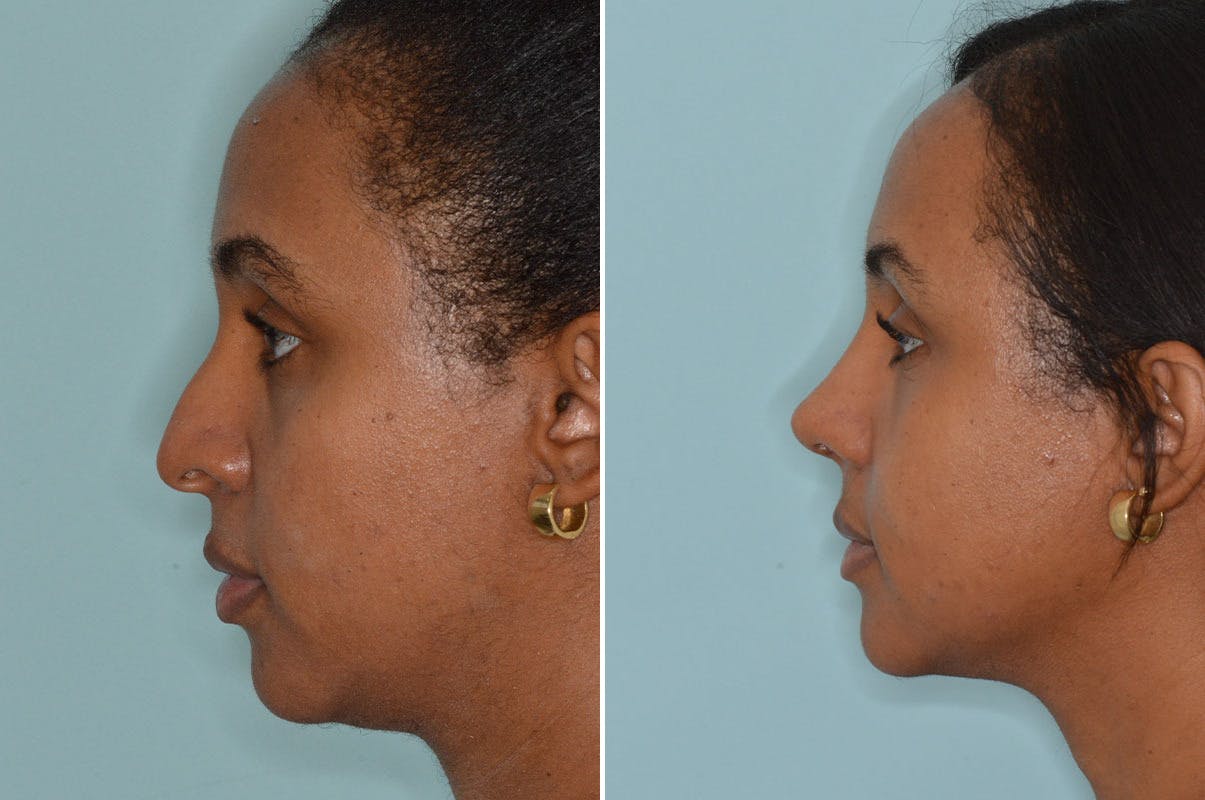 Ethnic Rhinoplasty before and after, lateral left.