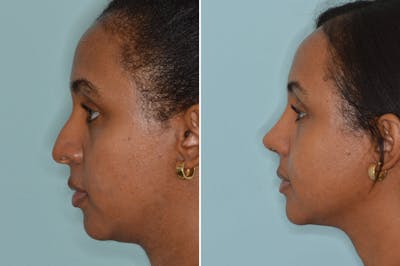 Ethnic Rhinoplasty before and after, lateral left.