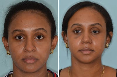 Ethnic Rhinoplasty before and after, frontal.