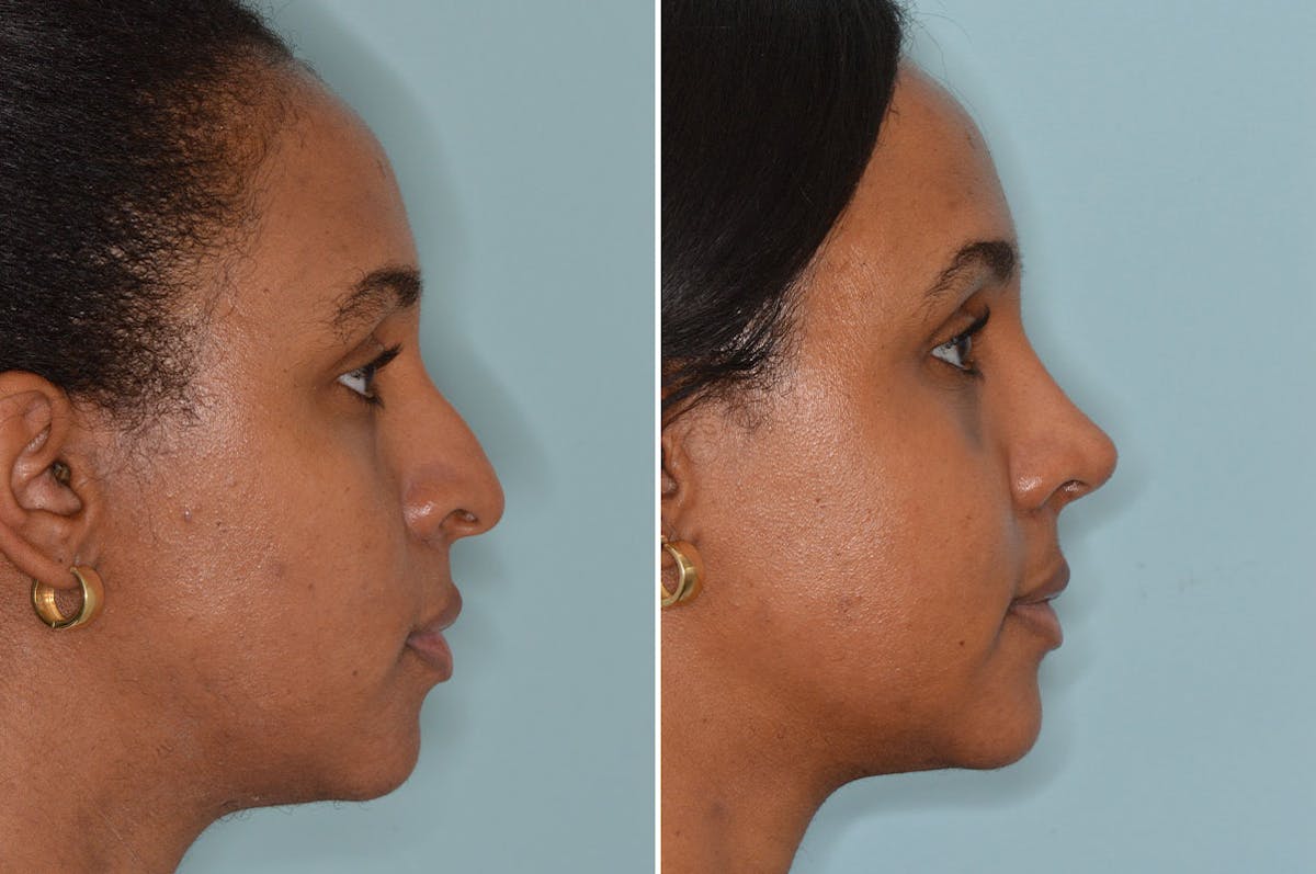Ethnic Rhinoplasty before and after, lateral right.