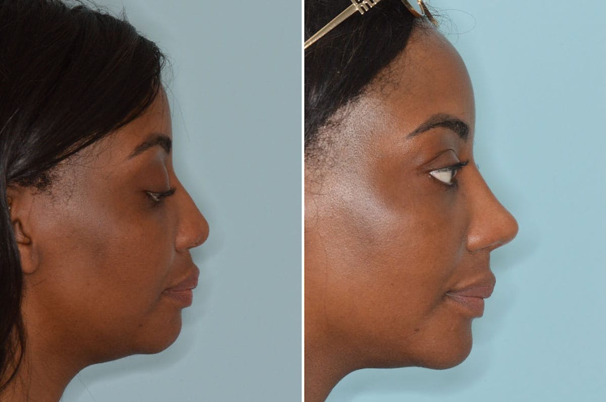 Ethnic Rhinoplasty before and after, lateral right.