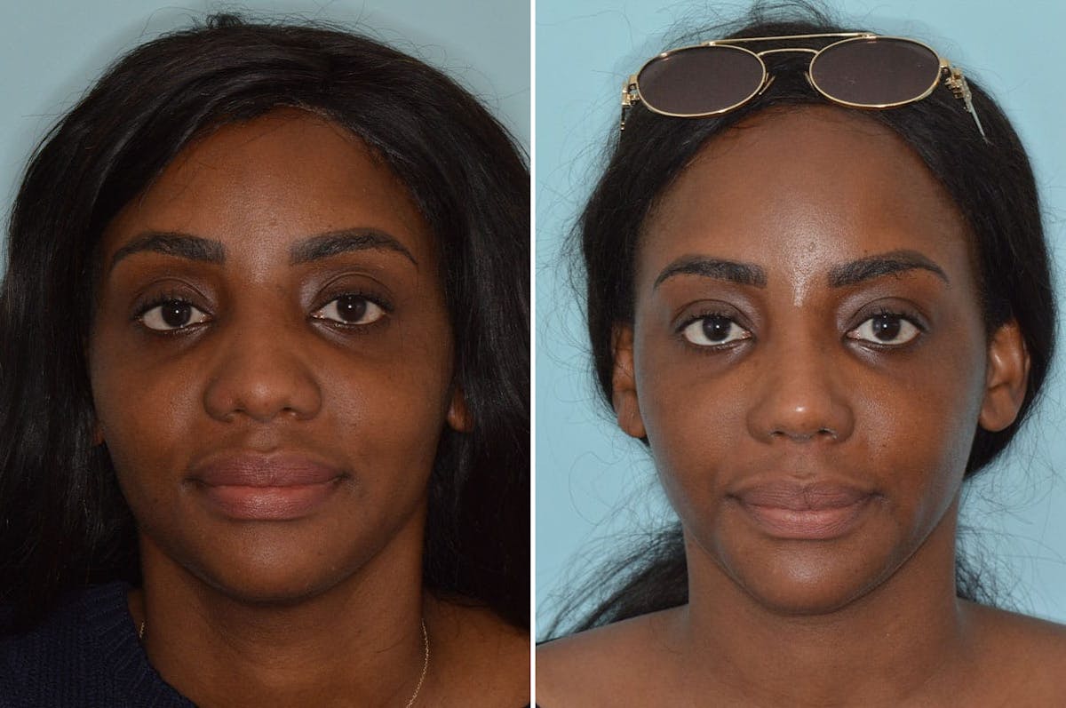 Ethnic Rhinoplasty before and after, frontal.