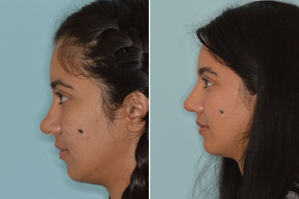 Ethnic Rhinoplasty before and after, lateral left.