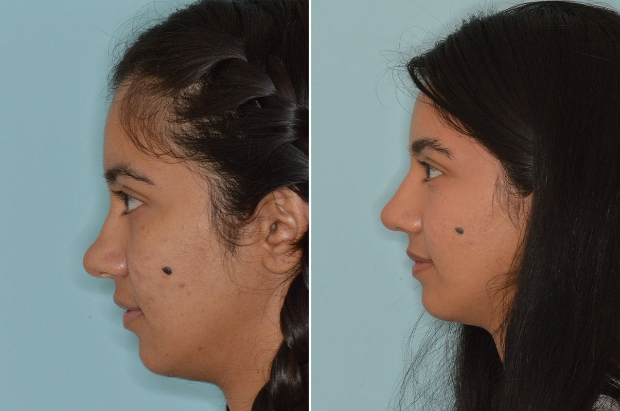Ethnic Rhinoplasty before and after, lateral left.