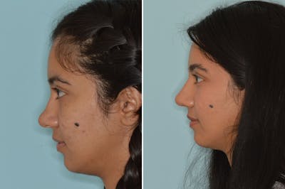 Ethnic Rhinoplasty before and after, lateral left.