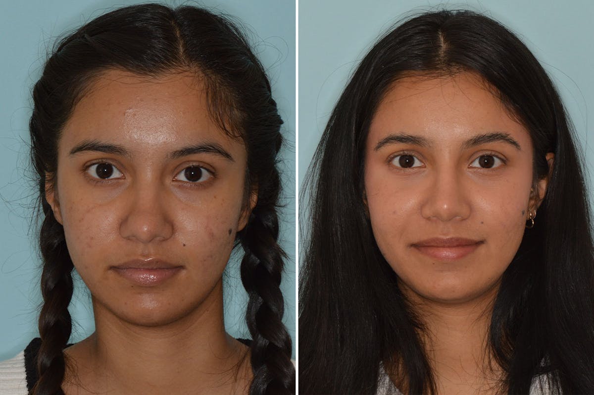 Ethnic Rhinoplasty before and after, frontal.