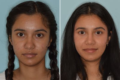 Ethnic Rhinoplasty before and after, frontal.