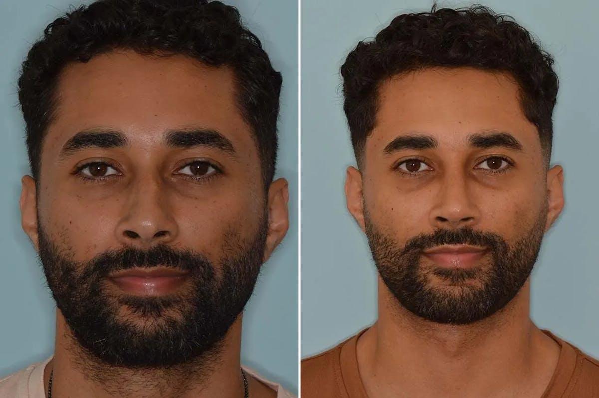 Ethnic Rhinoplasty before and after, frontal.