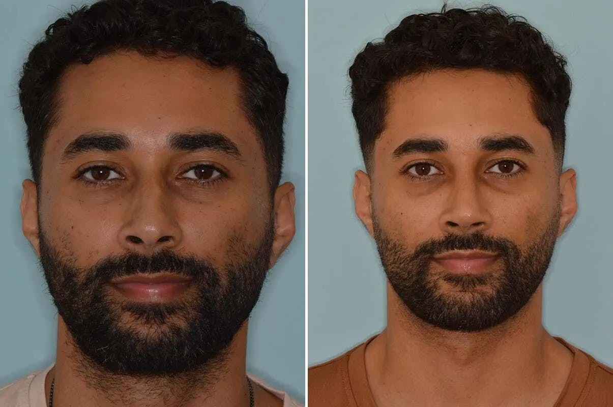 Ethnic Rhinoplasty before and after, frontal.