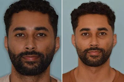 Ethnic Rhinoplasty before and after, frontal.