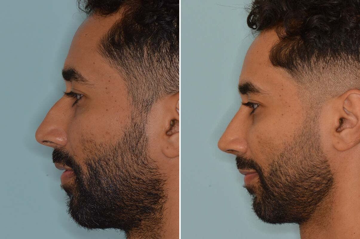 Ethnic Rhinoplasty before and after, lateral left.