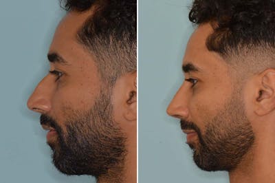 Ethnic Rhinoplasty before and after, lateral left.