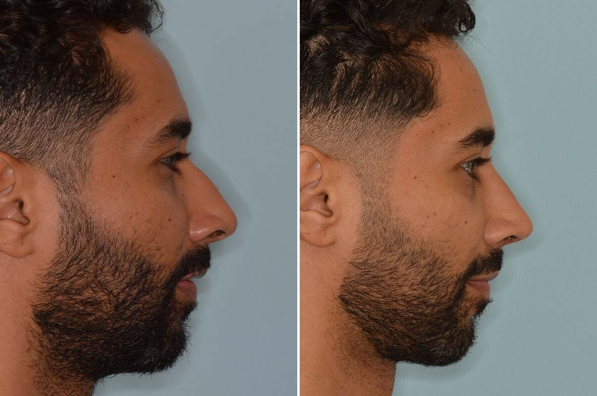 Ethnic Rhinoplasty before and after, lateral right.
