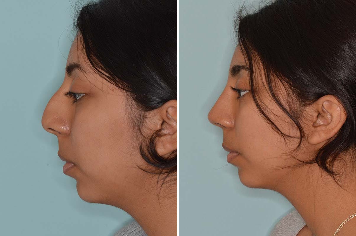 Ethnic Rhinoplasty before and after, lateral left.