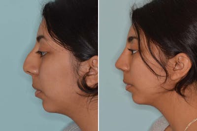 Ethnic Rhinoplasty before and after, lateral left.