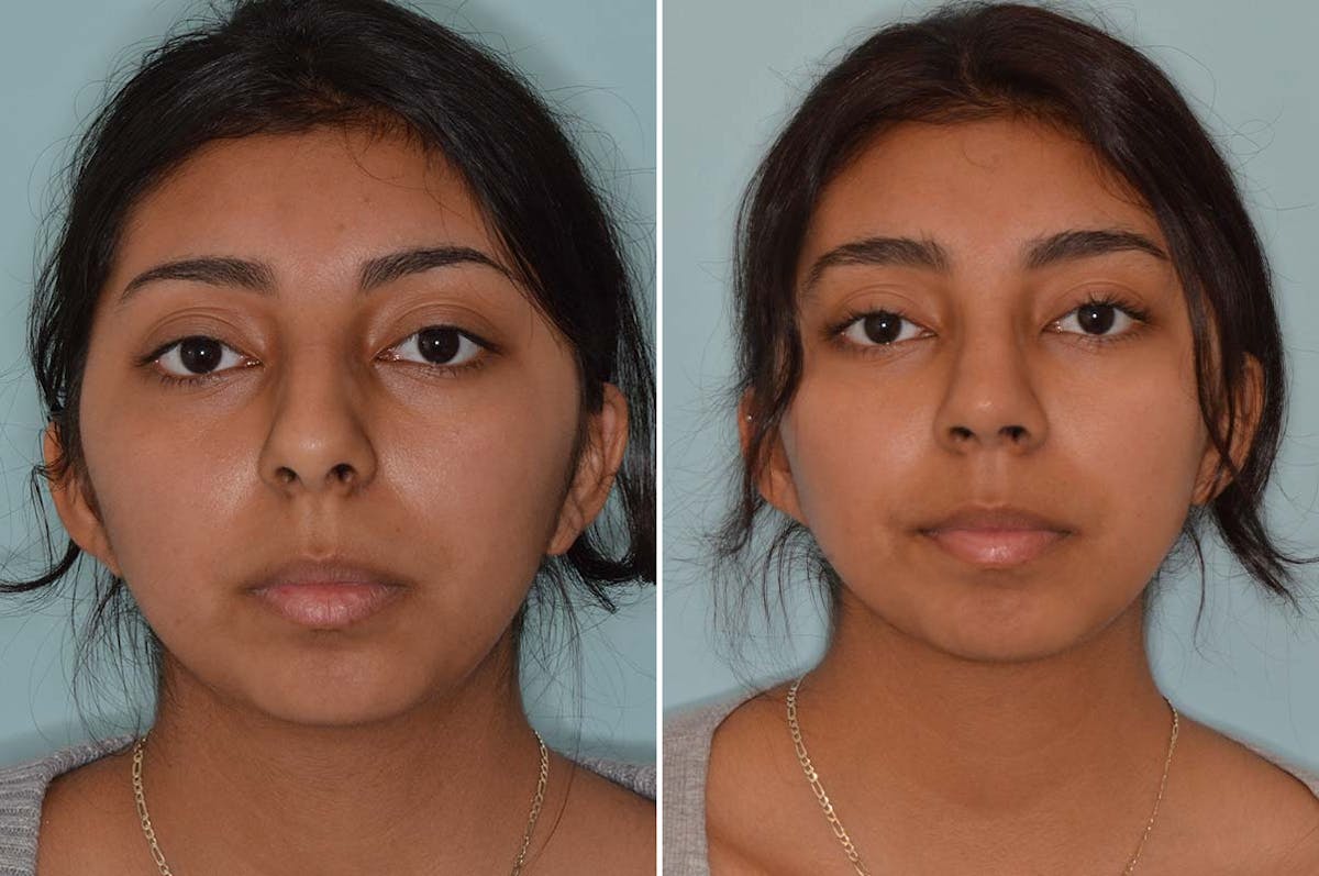 Ethnic Rhinoplasty before and after, frontal.