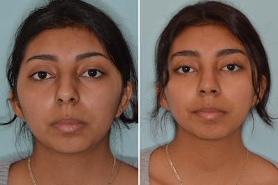 Ethnic Rhinoplasty before and after, frontal.